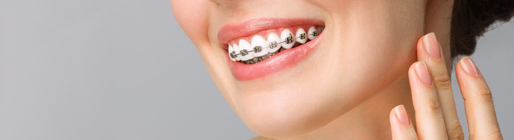 A girl smiling wearing the dental braces.