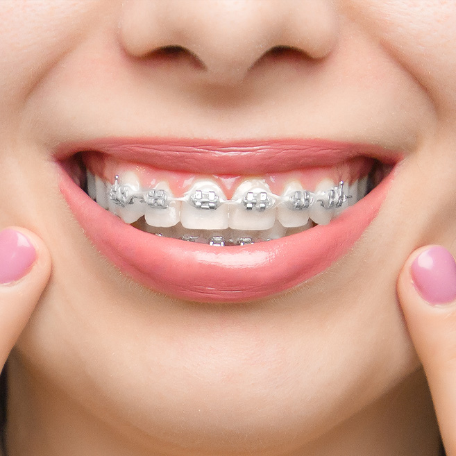 A girl having the teeth braces treatment for jaw alignment.