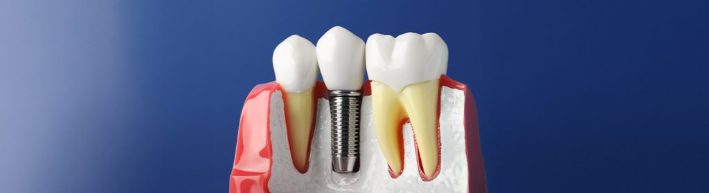 Types of dental implants