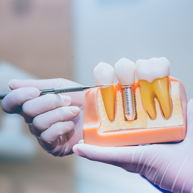 A dentist holding the tooth sample that shows the full dental implants process.