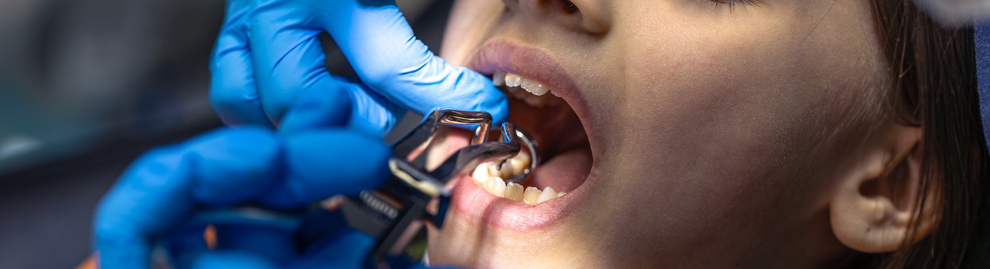 wisdom tooth extraction