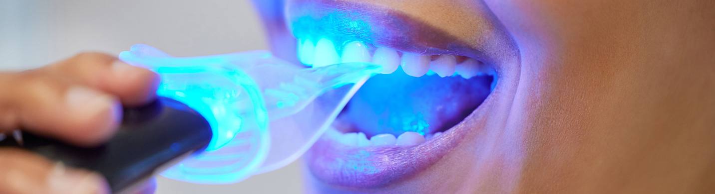 Laser teeth whitening is shown for the aesthetic look.