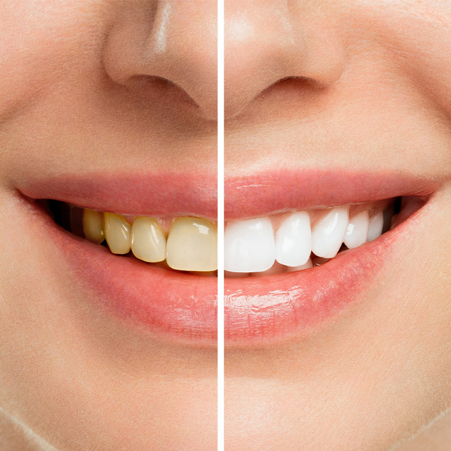 The before and after is shown for the teeth whitening process.