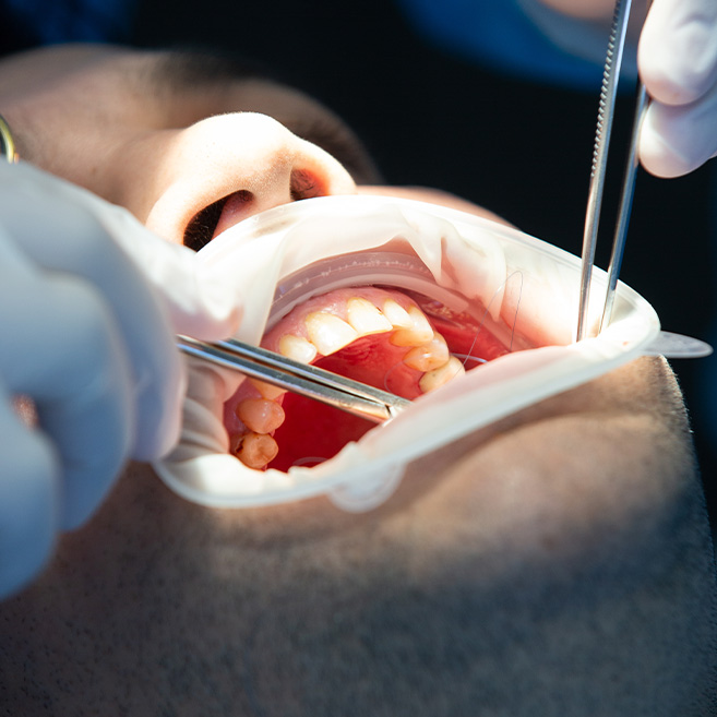 A patient is lying in front dentist that perform the root canal procedure.