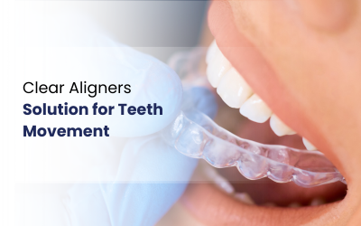 Aligner is placed on the teeth of patient for teeth alignment.