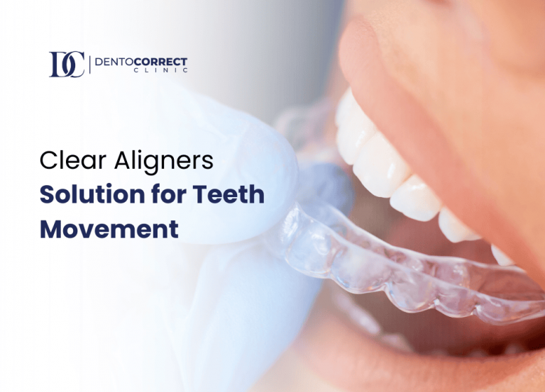 How Clear Aligners Move Teeth