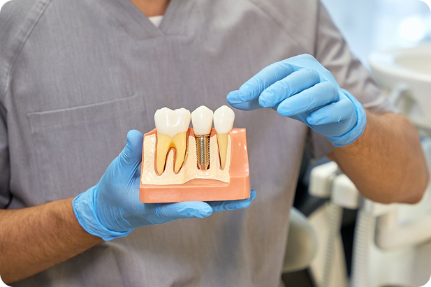A doctor holds the model that shows the dental implant process.