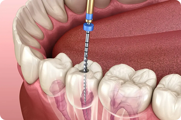 The dental tool file is used to perform the root canal treatment.