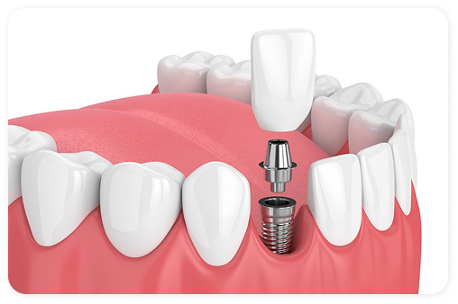 Single tooth dental implant.