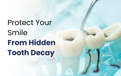 A dental tool is shown while removing the tooth cavity