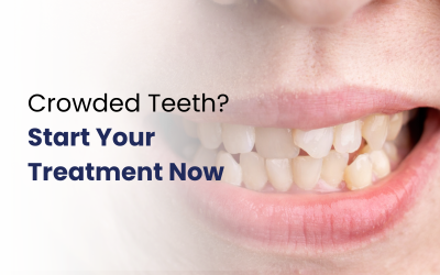 A girl opens her mouth to show her crowded teeth.