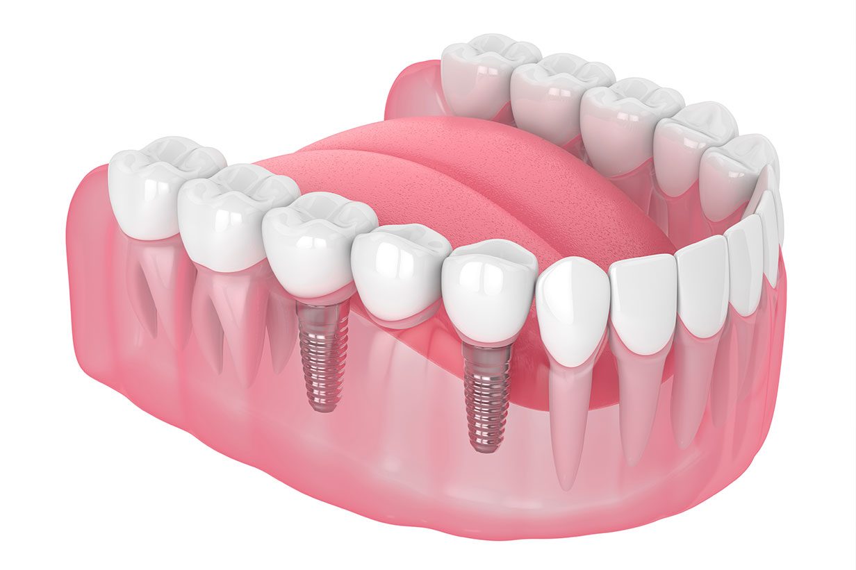 Implant supported bridge.