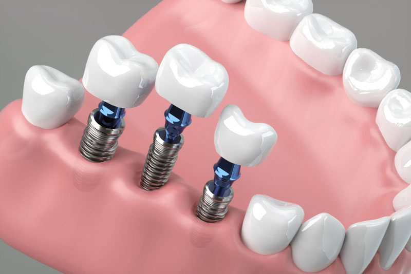 Multiple teeth dental implant.