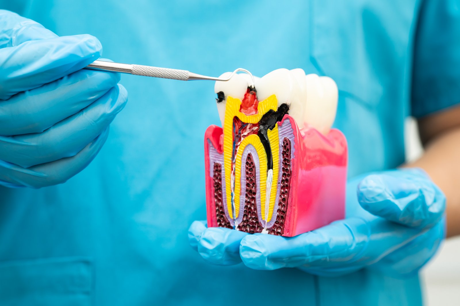 A dentist holds the teeth's model to show how a root canal is performed.