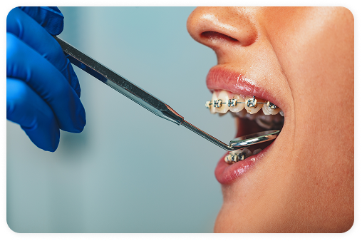 A dentist uses a dental tool for the treatment of dental braces.