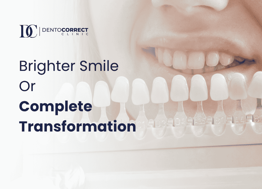 Dental Veneers vs Teeth Whitening